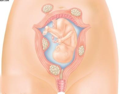 فیبروم رحم در بارداری چیست