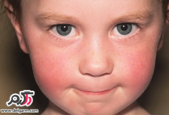 بیماری پوستی کودکان و علائم بیماری های پوستی کودک