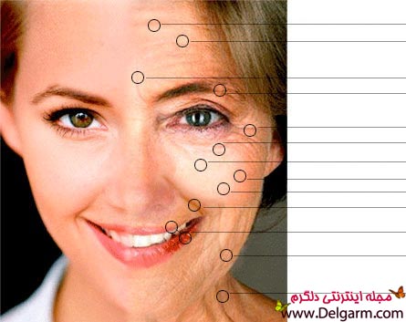 کاهش چین و چروک صورت با روش بوتاکس