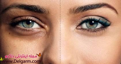سیاهی دور چشم و درمان اصلی آن