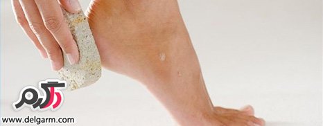 درمان ترک های پاشنه پا و پوست ضخیم زانو و آرنج