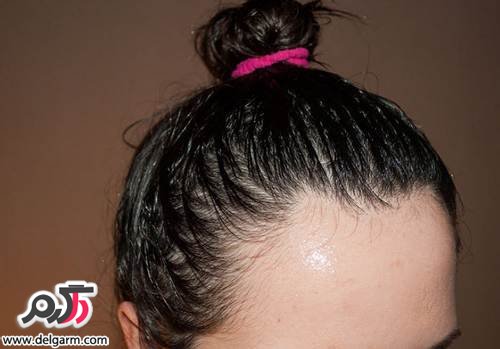 تاثیر استرس بر روی سلامت مو و پوست