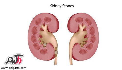 نکات خواندنی درباره سلامت کلیه ها