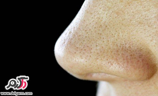 روش از بین بردن دانه های سرسیاه بینی روش از بین بردن دانه های سرسیاه بینی