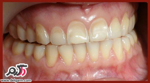فرسودگی و ساییدگی مینای دندان
