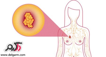 چگونه از سرطان سینه پیشگیری کنیم؟