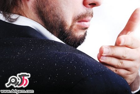 روشهای طبیعی برای درمان شوره سر