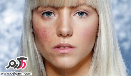 همه چیز درباره جوش صورت همیشگی