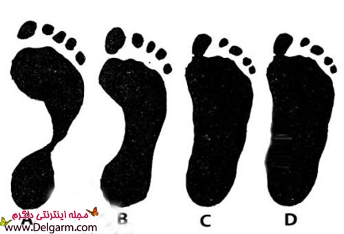 علت های صافی کف پا + عکس