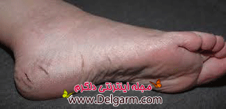 ترک پا ترک پا