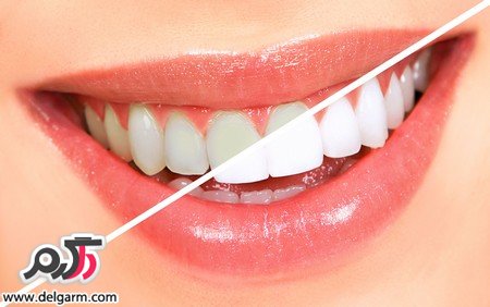 روش هایی برای سفید شدن دندان