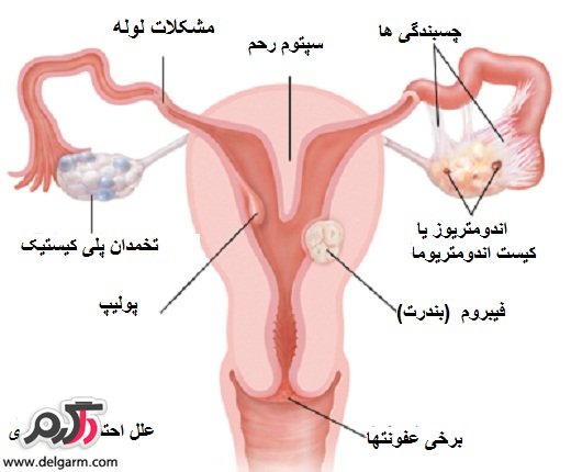درمان ناباروری در زنان و مردان