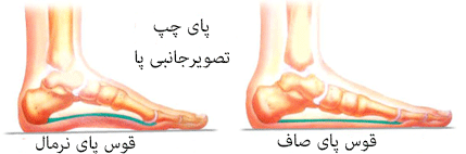 صافی کف پا چیست؟