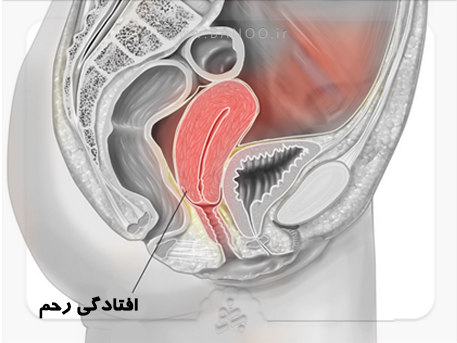 چه عواملی خطر افتادگی رحم را افزایش می دهد؟
