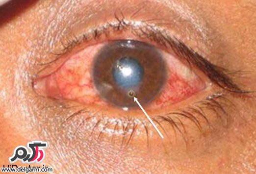 علایم عفونت چشم