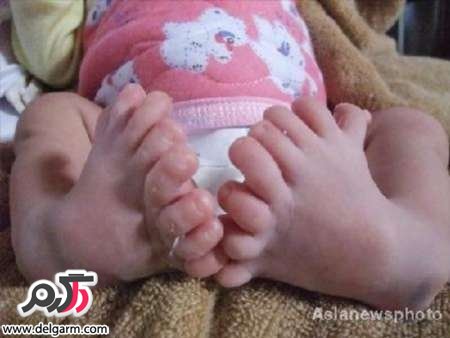 نوزاد 31 انگشتی چینی نوزاد 31 انگشتی چینی