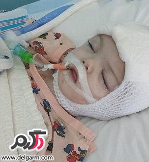 جدایی دوقلو های بهم چسبیده ی پسر