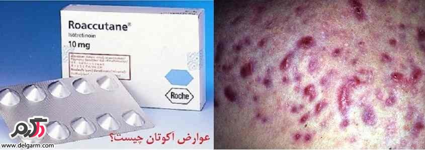 عوارض راکوتان
