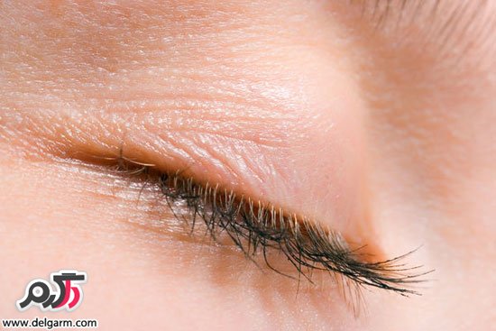 درمان خشکی پلک چشم