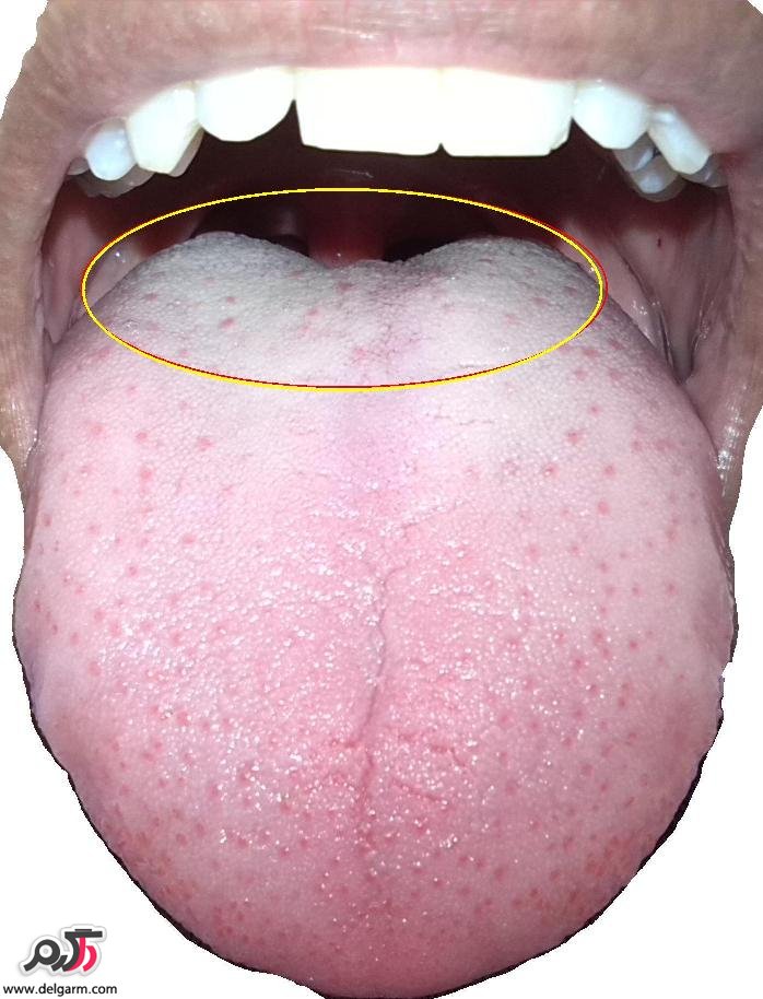 علت تلخی دهان چیست؟