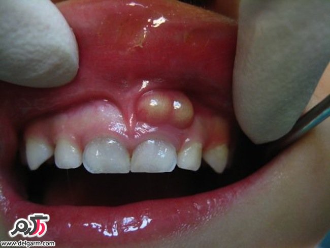 آشنایی با آبسه دندان و درمان آن