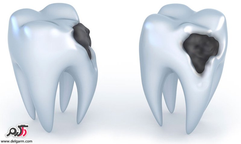 علل خرابی دندان ها