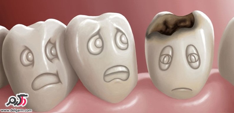 علت های ایجاد پوسیدگی و خرابی دندان