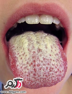 برفک دهان چیست؟ علل، علائم، تشخیص و درمان برفک دهان