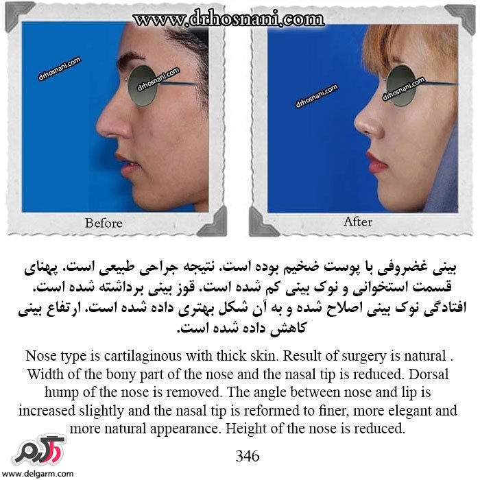 جراحی زیبایی بینی‌ (رینوپلاستی) 