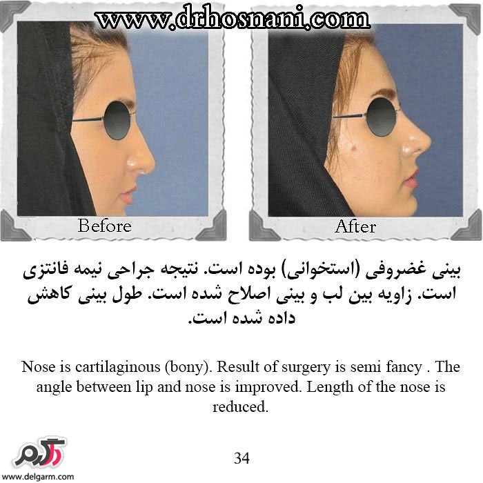 جراحی زیبایی بینی‌ (رینوپلاستی) 