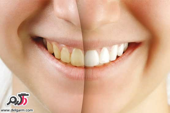 ماده غذایی ایجادکننده جرم دندان 