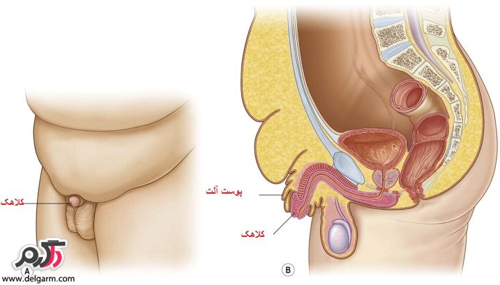 آلت تناسلی دفن شده