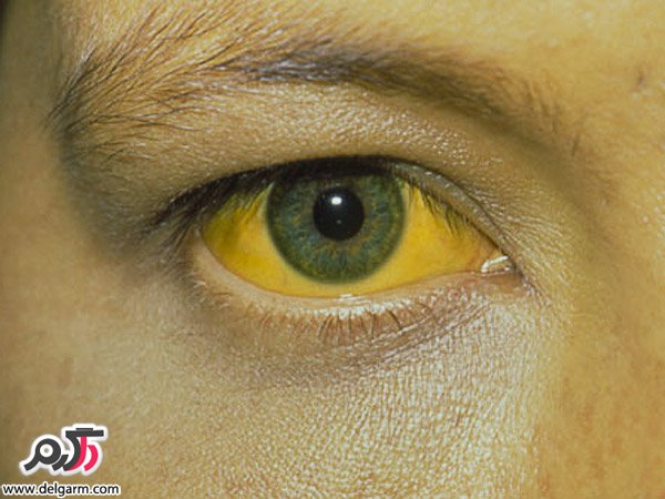 علت زردی چشم یا سندرم ژیلبرت چیست ؟