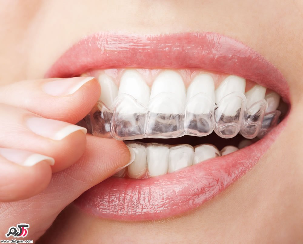 بلیچینگ دندان چگونه اثر می‌کند؟