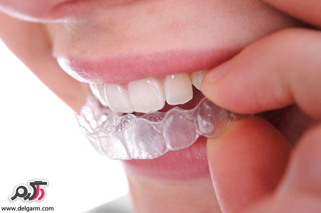 بلیچینگ دندان چگونه اثر می‌کند؟