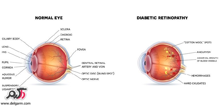  بيماري هاي چشمي مرتبط با ديابت