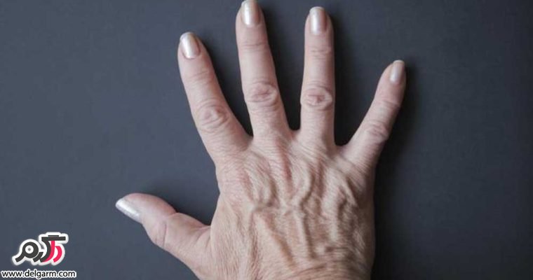 علت تورم و برجستگی رگهای پشت و روی دست چیست؟