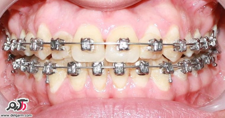 علت پوسیدگی دندان در زمان ارتودنسی