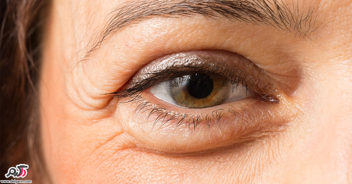 درمان‌ خانگی عفونت چشم