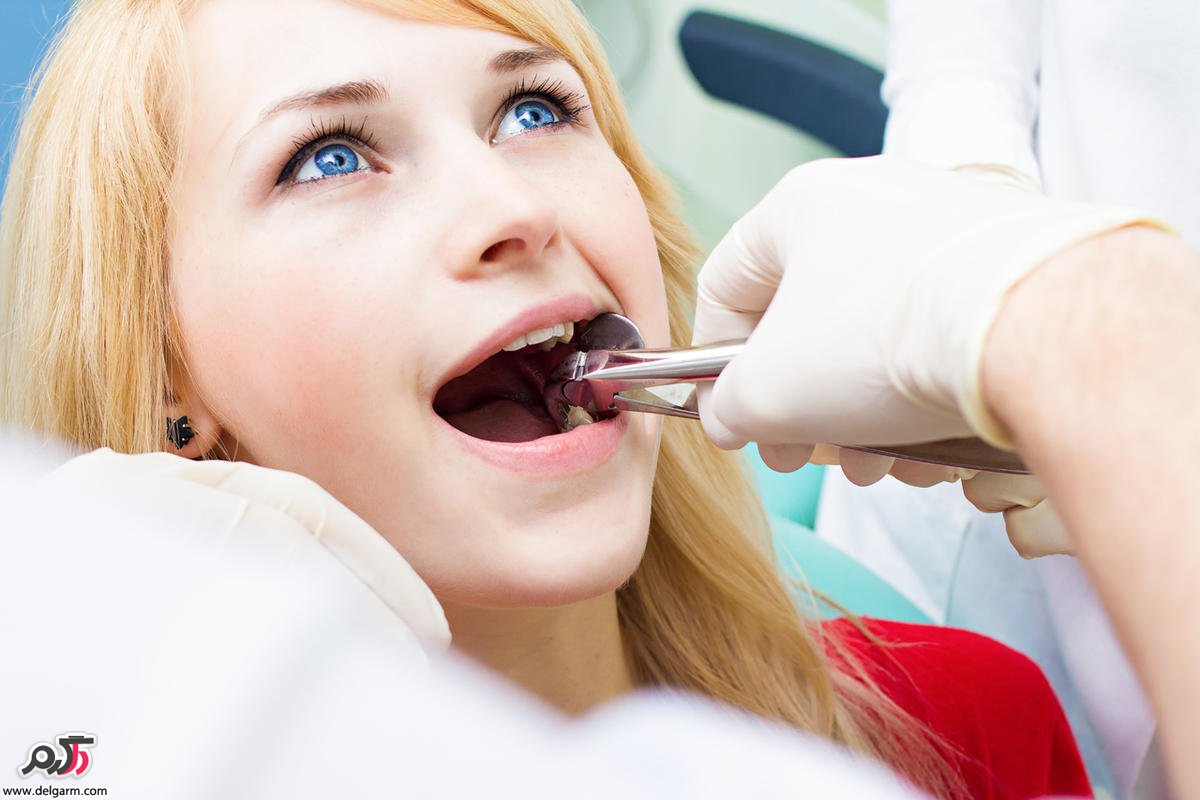 Pulling the wisdom tooth