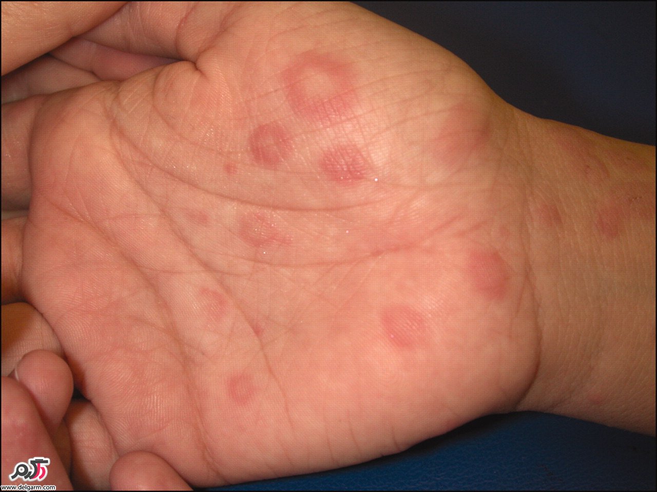 Itchy Red Rash On Hands And Feet Foot Rash Causes Symptoms And – NBKomputer