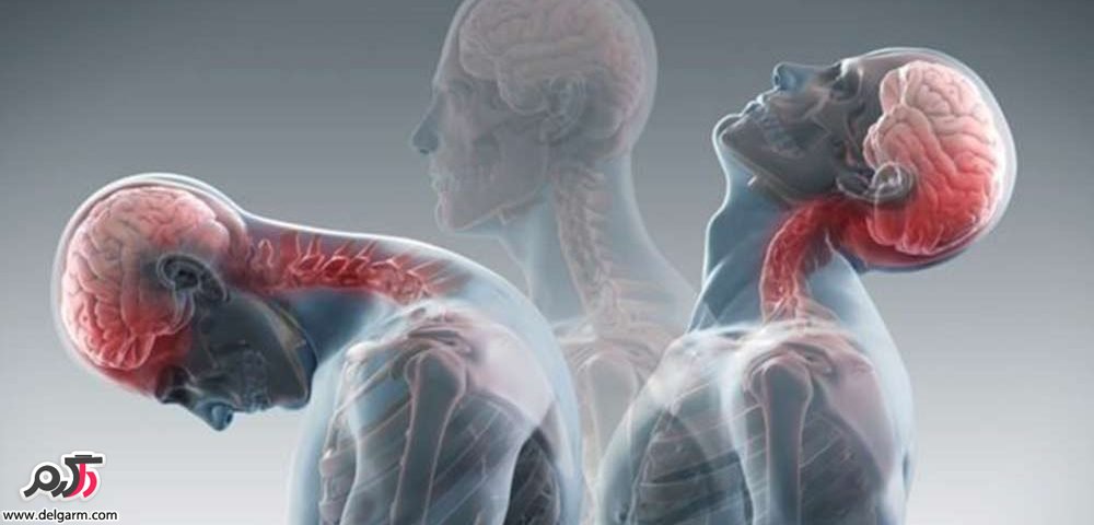  کشیدگی و رگ به رگ شدن گردن از علل مهم گردن درد است