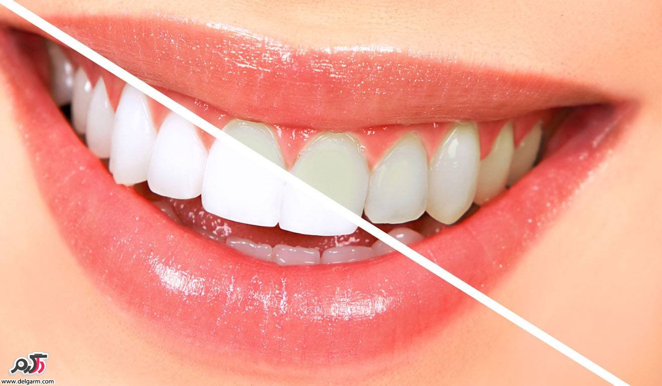 زردی دندان از چیست؟