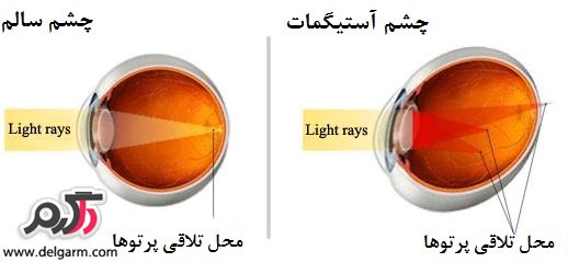 آستیگماتیسم
