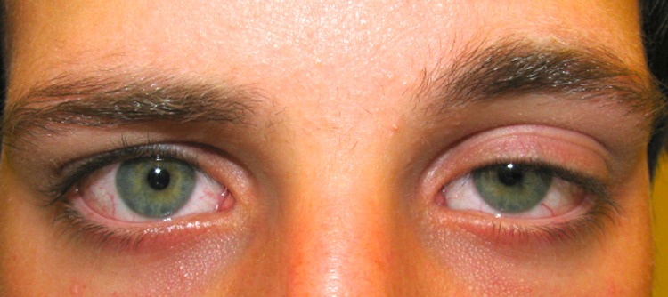  درباره بیماری چشمی پتوز چه میدانید