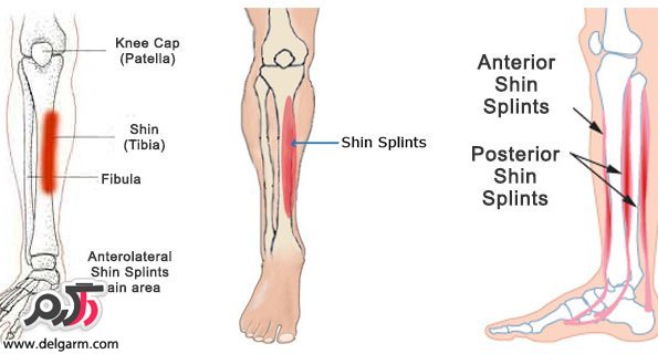 تشخیص درد ساق پا