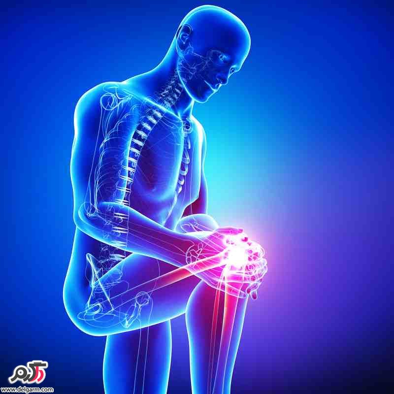 علائم و درمان پارگی رباطهای صلیبی و طرفی زانو علائم و درمان پارگی رباطهای صلیبی و طرفی زانو