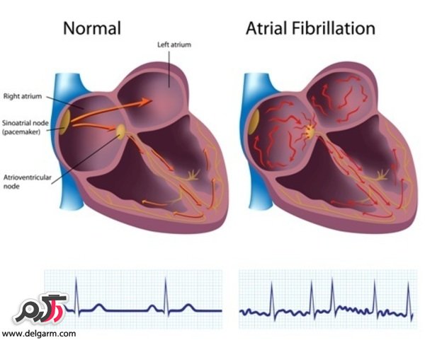 بیماری قلبی فیبریلاسیون دهلیزی