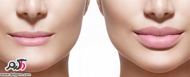 برجسته سازی لب با حجم دهنده های طبیعی