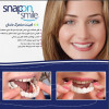 قیمت Snap On Smile